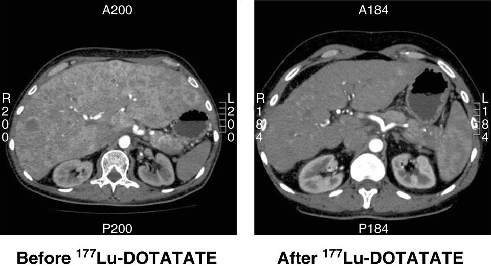 Lutetium-177 treatment CT scan